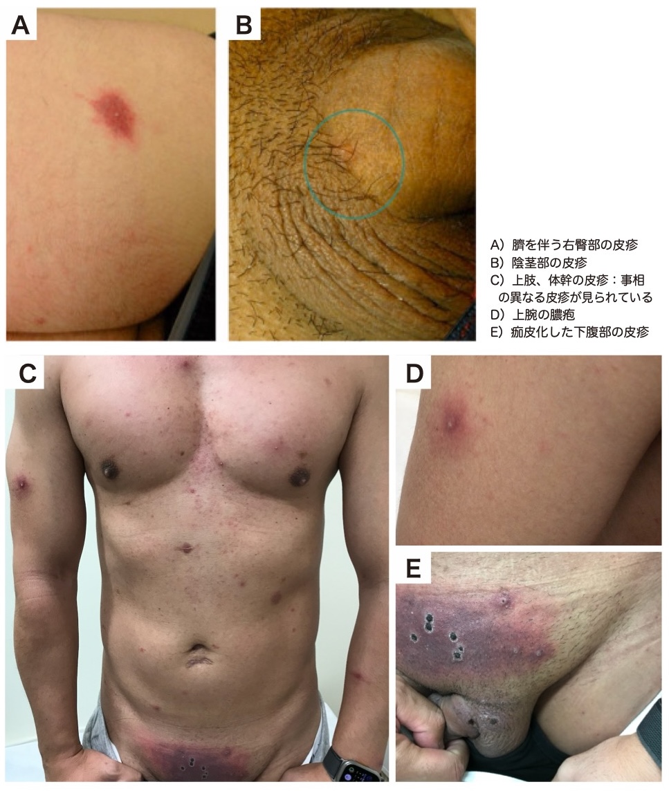 図2-1 エムポックスの皮疹